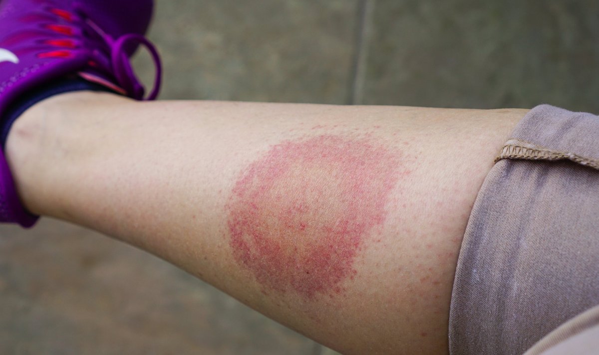 Kõige kindlam puukborrelioosi tunnus on laienev punane laik, mis tekib puugihammustuse kohale. Mõnikord seda aga ei teki. 
