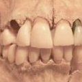 Ligi kahe aastatuhande vanune mõistatus – miks vanaaja brittidel nii terved hambad olid?