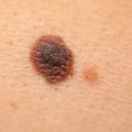 Dermatoveneroloog: enne 15. eluaastat saadud UV-kiirgus tõstab oluliselt melanoomi haigestumise riski