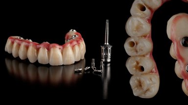 Millised on hammaste proteesimise võimalused?