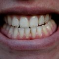 Hambaarstid avaldavad VIIS märki, mis vihjavad, et krigistad öösiti hambaid