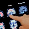 Läbimurre Alzheimeri tõve ravis? Jah, kui haigus diagnoositakse varakult