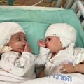 ВИДЕО | Лицом к лицу в первый раз. В Израиле разделили сросшихся затылками близнецов
