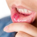 Kui suu läheb seest katki: igemepõletiku ja suu limaskesta põletiku põhjused on erinevad