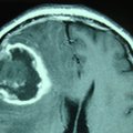Doktoritöö: agressiivseima ajukasvaja mõistatus