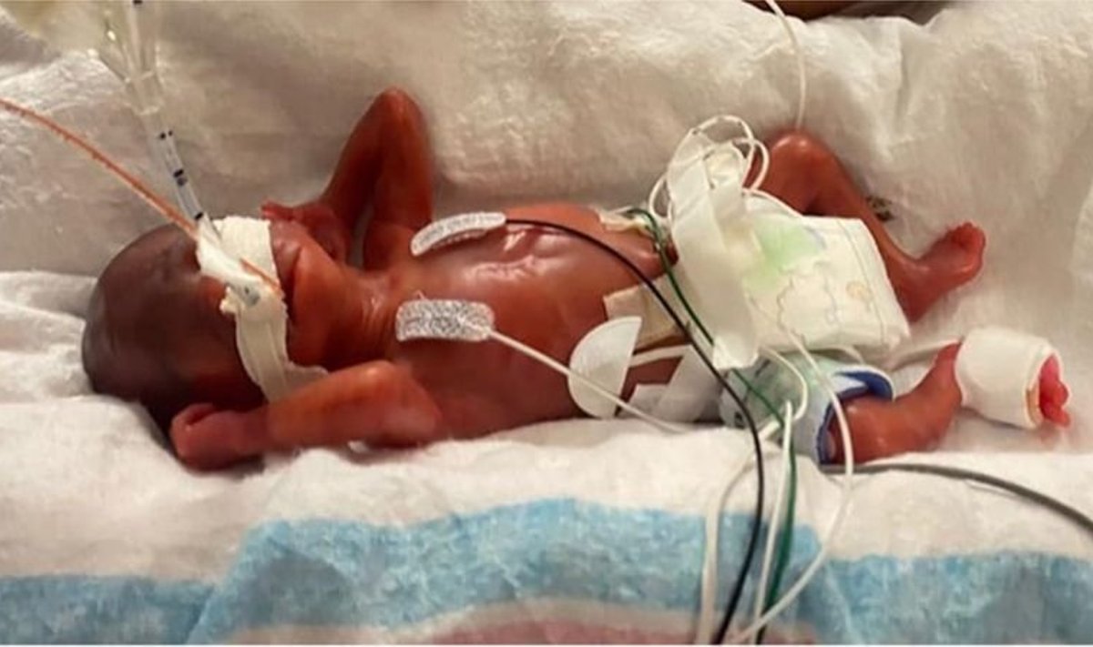 Кертис Минс родился на 19 недель раньше положенного срока