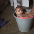 В Колумбии 20 тысяч человек заболели лихорадкой Зика