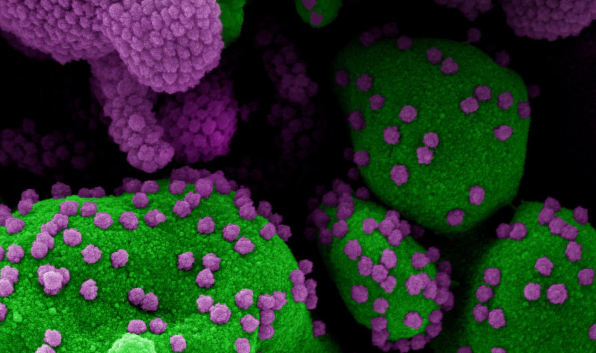 SARS-CoV-2 viiruse osakestega (lilla) tugevalt nakatunud apoptootilise rakk (roheline)