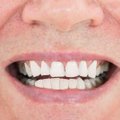 Suuhingamine tekitab rohkelt hambaprobleeme! Mis seda põhjustab ja kuidas ravida?