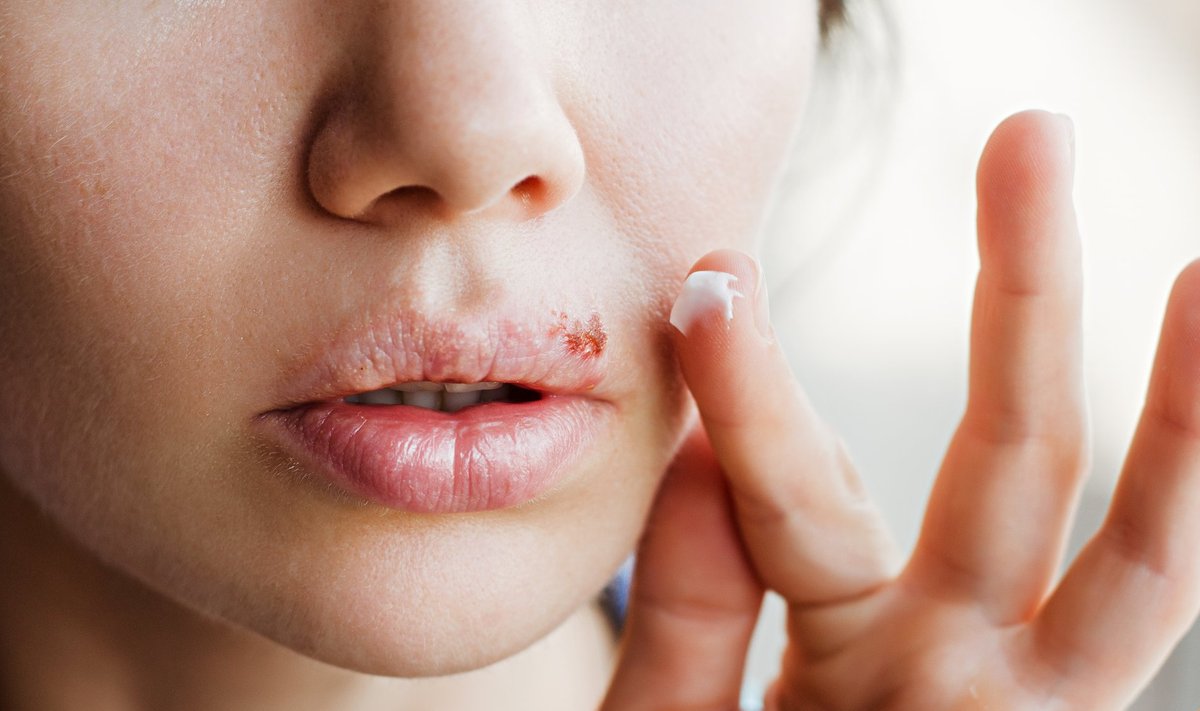 Paikne huuleherpese ravi vähendab küll ebamugavustunnet, kuid ohatise paranemist siiski ei kiirenda
