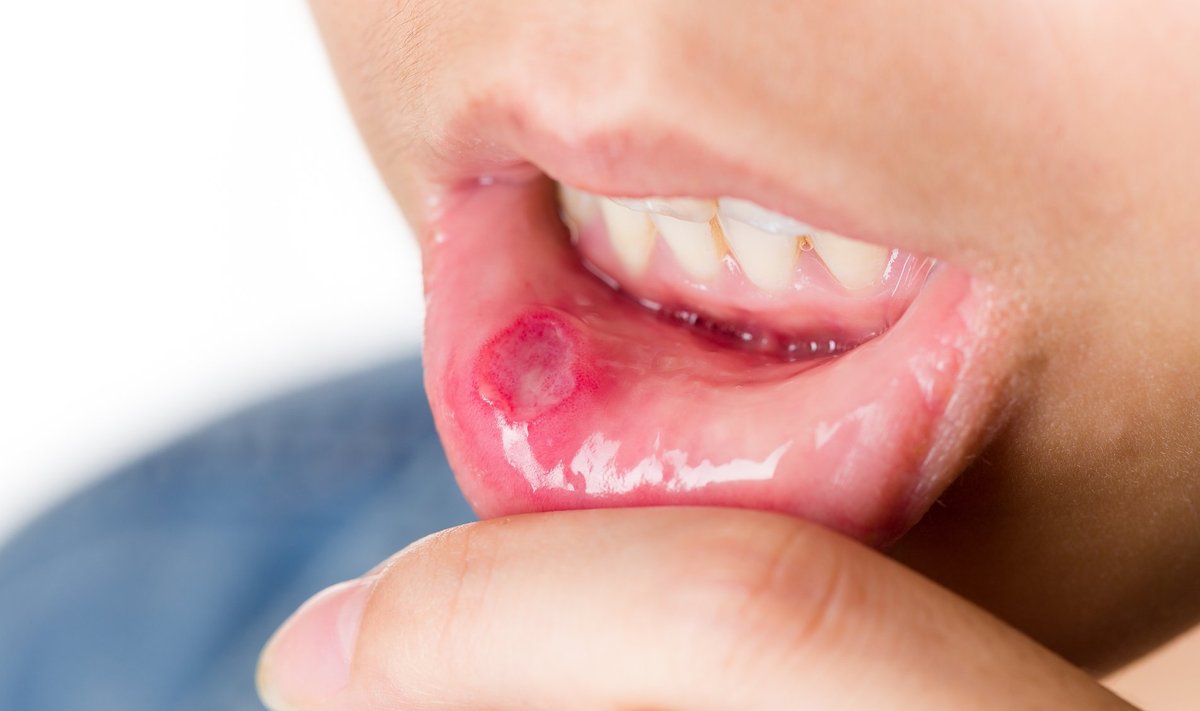 Aftid suus teevad palju valu. Nende tekkepõhjust ei teata, seega puuduvad ka head abinõud nende ärahoidmiseks.