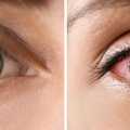 Sagedased silmamured rahetera ja odraiva. Kuidas neid eristada ja nende tekkimist ära hoida?