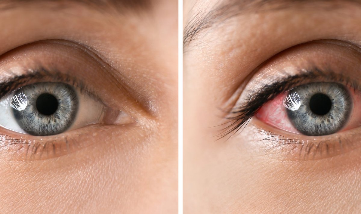 Young,Woman,Without,And,With,Eye,Redness,,Closeup