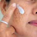 Kosmeetik hoiatab: just see häire on oluline tegur pigmendilaikude tekkeks
