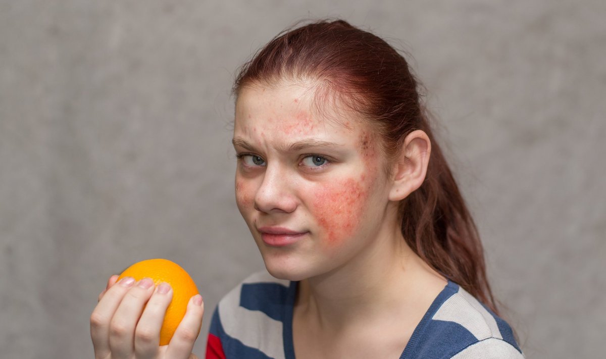 Toidutalumatuse kaebused, enamasti nahalööbe- või seedetraktikaebused, on sageli allergiaga äravahetamiseni sarnased.