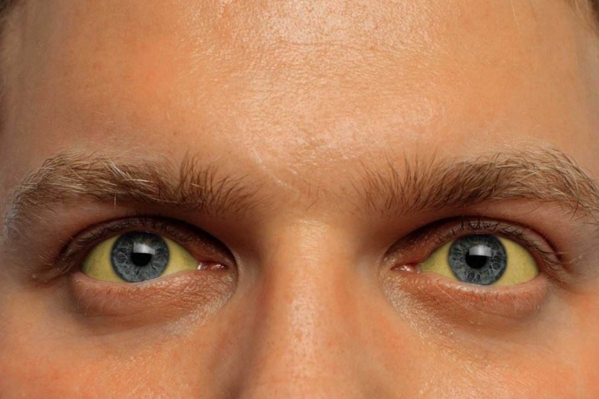 Описание желтых глаз. Пожелтение склер гепатит. Глаз человека.