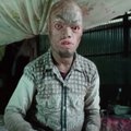 India mees vahetab haruldase haiguse tõttu iga nädal nahka