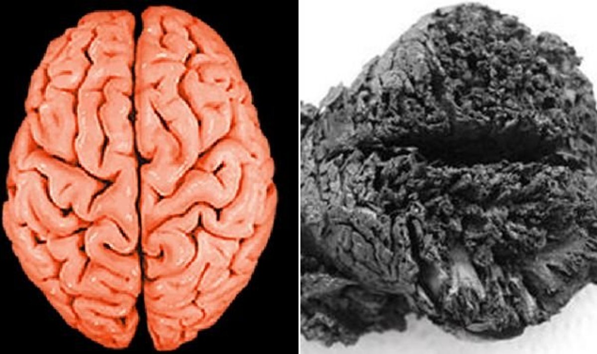 Värske aju ja 4000 aastat vana aju võrdlus. Foto: Istanbuli Halici ülikool