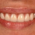 ДО И ПОСЛЕ | Отсутствующие зубы – это в прошлом!