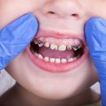 Lapsevanemad, tähelepanu! Need on väikeste laste hambahoolduse põhitõed, et suus ei avaneks jube vaatepilt