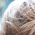 Karm, aga tõsi: eestlaste juukseid räsib enim väljalangemine ja hõrenemine — kuidas probleemile lahendus leida?